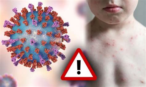 Europe Holiday Warning Measles Mumps And Rubella Fears Britons Urged