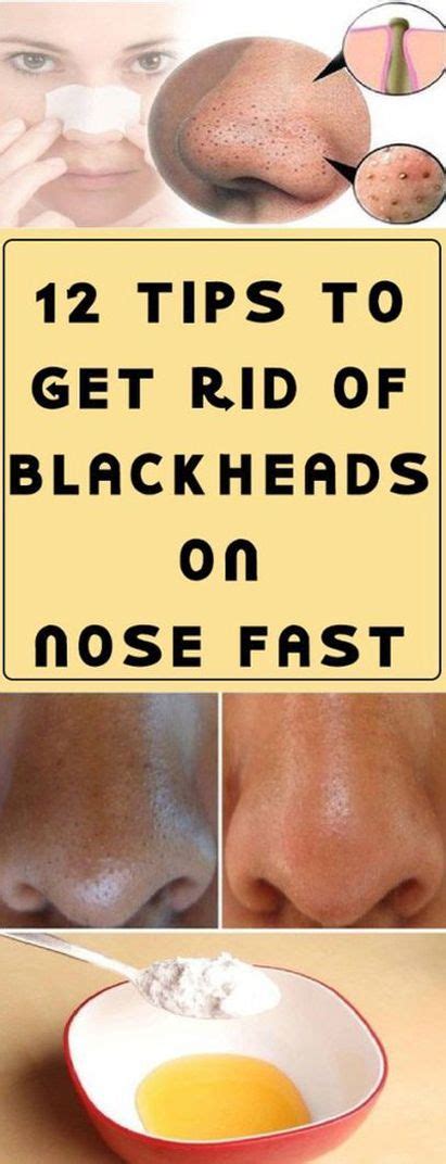 12 Tips To Get Rid Of Blackheads On Nose Fast Because Of This In This Post Well Discuss The