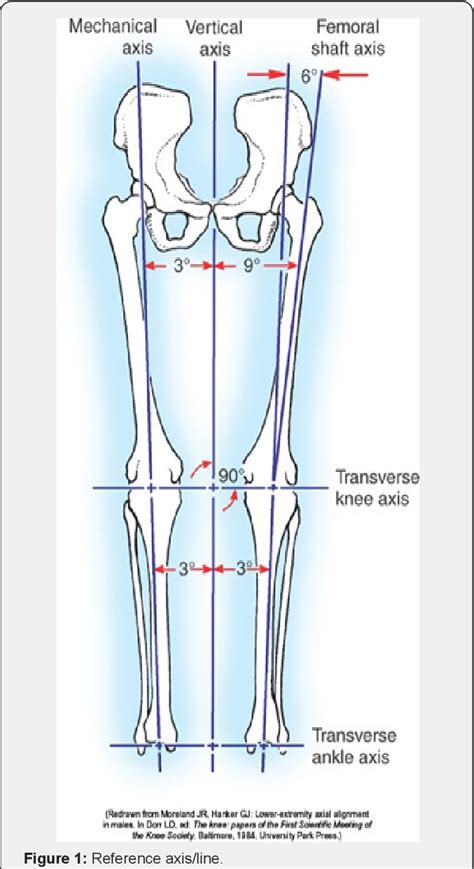 Figure 1 From Component Alignment In Total Knee Replacement Semantic