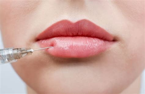 Most Popular Lip Fillers That Make Your Pout Last Really Long