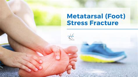 Foot Stress Fracture Doctor Care And Treatment