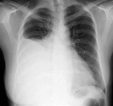 Acute hydrothorax complicating peritoneal dialysis: pleural effusion | pathology | Britannica.com