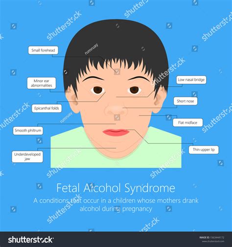 Protrusion of the lower jaw (prognathism); Flat Nasal Bridge And Epicanthal Folds : Flat Nasal Bridge ...