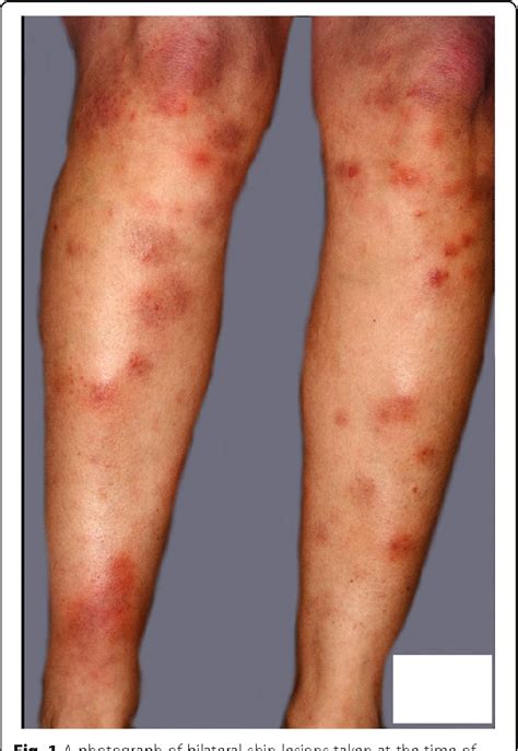 Pdf Erythema Nodosum As A Result Of Estrogen Patch Therapy For