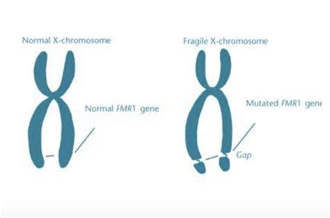 Fragile X Syndrome Karyotype