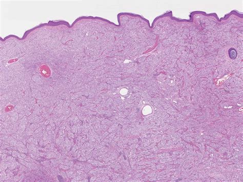 Fyarro First Drug To Treat Perivascular Epithelioid Cell Tumor