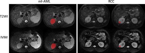 Frontiers Mri Based Radiomics And Urine Creatinine For The