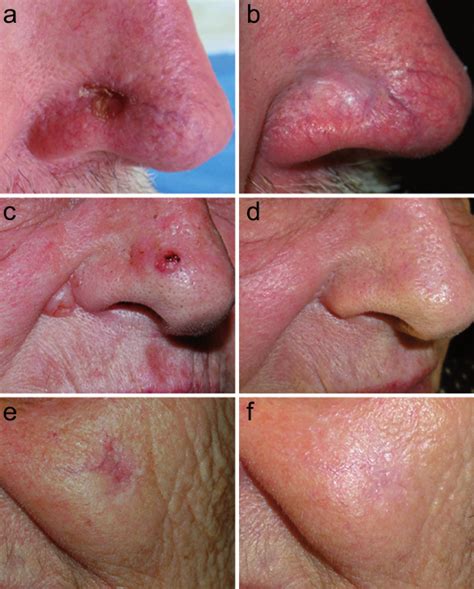 Immunocryosurgery For Non Superficial Basal Cell Carcinoma A Pro My