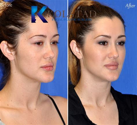 Natural Cheek Augmentation With Vollure And Voluma San Diego Gallery 12