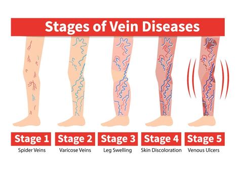 The Stages Of Vein Disease — Physicians Vein Clinics