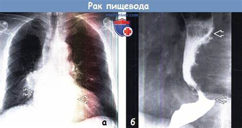 Рак пищевода и диета