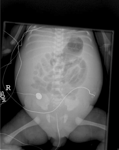 An Abdominal Radiograph Demonstrating Abdominal Urinary Ascites As A