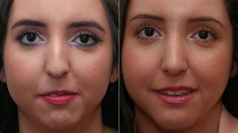 Rhinoplasty | Melbourne ENT | Stephen Kleid | Ear, Nose and Throat Surgeon