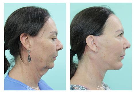 Chin Liposuction And Double Chin Surgery In Tijuana Mexico Vida