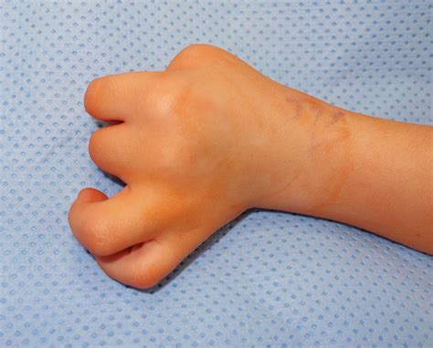 The Hand In Arthrogryposis Congenital Hand And Arm Differences