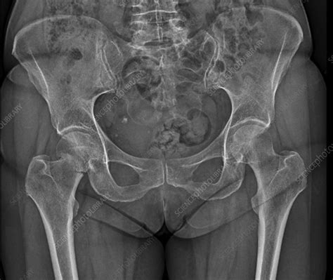 Hip Fracture X Ray Stock Image C0371465 Science