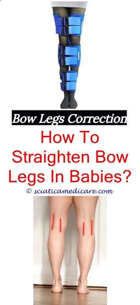 Permanent Remedy For Bow Legs What Causes Bow Legs In Teenagershow