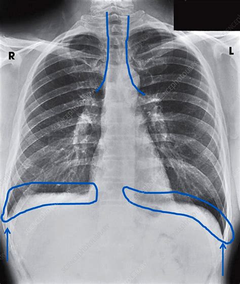 Chest X Ray Showing Costophrenic Angles Stock Image C0429927