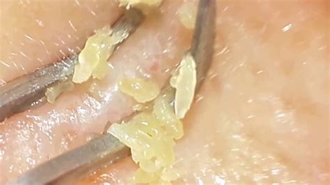 Huge Yellow Clogged Pores Removal With Clip Curved Tweezers Blackheads