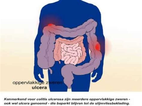 Colitis Ulcerosa Wat Zijn De Symptomen En Behandeling Van Colitis
