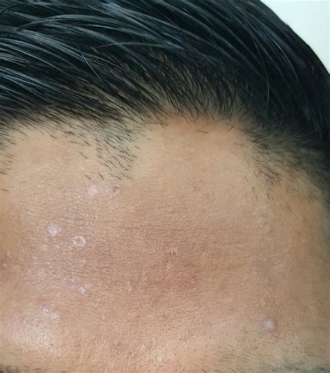 Need Advice Pics Hyperpigmentation Scars And Spots