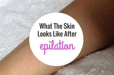 What The Skin Looks Like After Epilation • Epilator Central Before