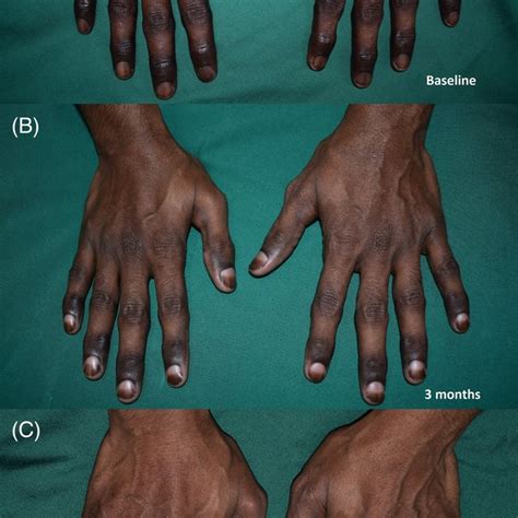 A Involvement Of Bilateral Hands With Marked Accentuation Of