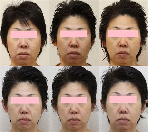 50歳の方が変身中です！ お顔のたるみを改善 自由が丘 東京のリフトアップエステサロン 東京の自由ヶ丘にあるリフトアップエステサロン「ビューティーセラピーマジック」は、お顔のたるみ