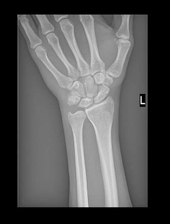 Triquetral Fracture Radiology Reference Article Radiopaedia Org