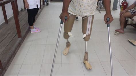 Full Length Transfemoral Prostheses For Bilateral Amputee Amputee