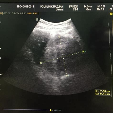 Selain itu, penyebab lain mengandung tapi period ialah kerana tahap hormon progesterone dalam badan amat. Kes: Tumor dan Fibroid | Poliklinik Mazlina
