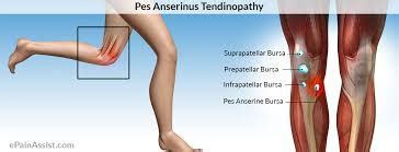 Pes Anserine Bursitis Pro Dynamic Physical Therapy Inc