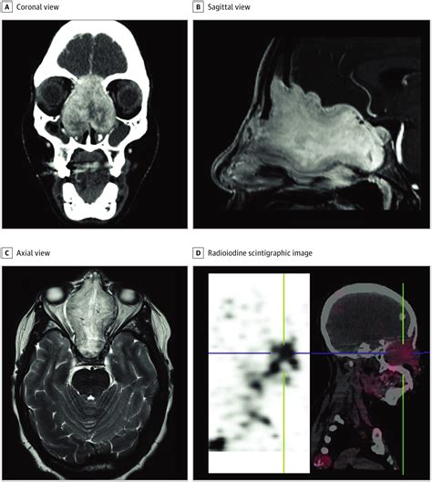 An Uncommon Sinonasal Metastasis Head And Neck Cancer Jama