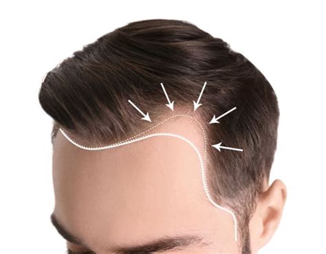 What Causes Uneven Hairline Can It Be Fixed