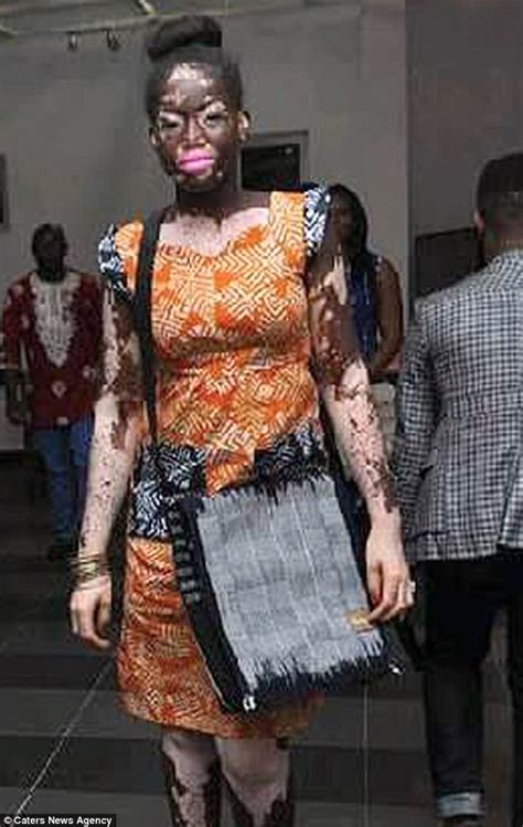 Enam Heikeens With Vitiligo Now A Model After Bullying Daily Mail Online