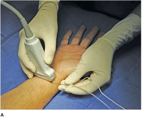 Ultrasound Guided Wrist Block Hadzics Peripheral Nerve Blocks And