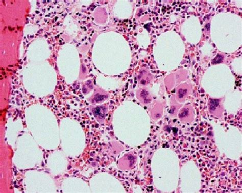 Bone Marrow Biopsy In Essential Thrombocytosis Showing Increased