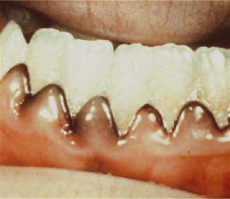 Check spelling or type a new query. Physical and Chemical Injuries - Pathology Oral with Kahn at Tufts University Dental School ...