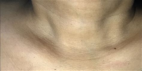 Painful Clavicular Swelling In A Female Ijem Case Reports