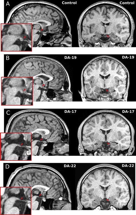 E Mammillary Bodies In A Control Participant A And In Three Patients