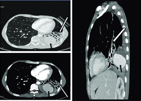 Chest Ct Showing Blood Filled Cavitary Lung Lesion Black Arrows The