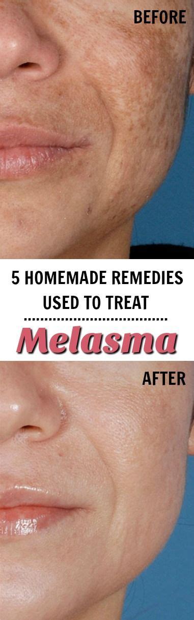 Pin On Melasma Cures