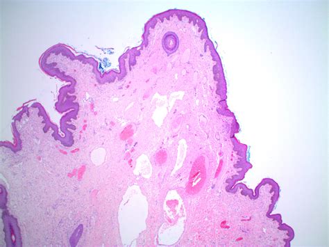 Pathology Outlines Cutaneous Fibroepithelial Polyps Free Hot Nude