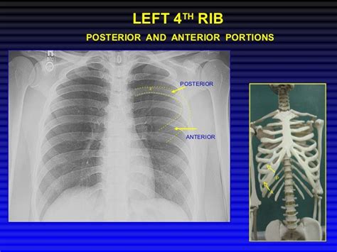 Chest Xray