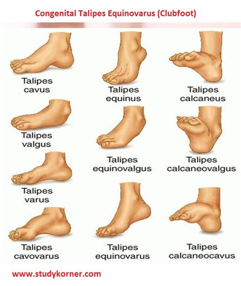 Congenital Talipes Equinovarus Clubfoot Nursing Cheat Sheet Studypk