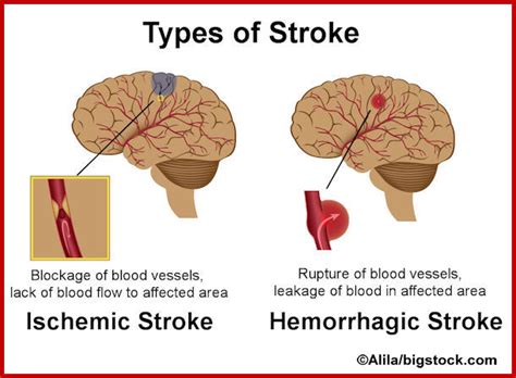 Ais ϭ acute ischemic stroke; Causes - Lifestyle Diseases - StrokeAmy Twyford