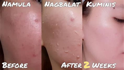 Fairy Skin Derma Facial Set Before And After Youtube