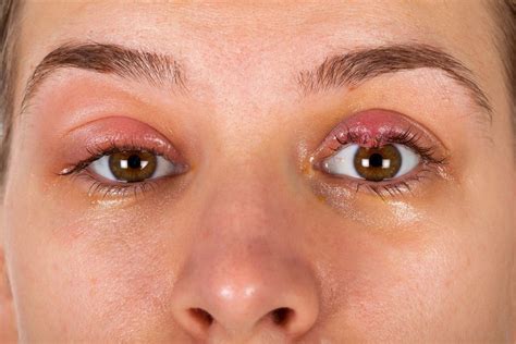 Chalazion Bump On Eyelid Causes And Treatment The Eye News