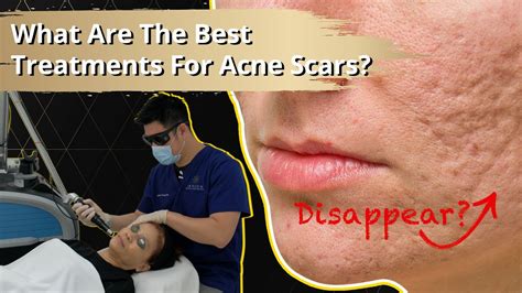 What Are The Best Treatments For Acne Scars Youtube