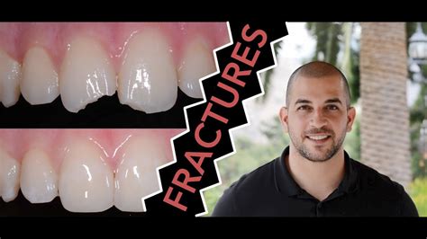 How To Repair A Broken Tooth With Dentist Filling Dentist Youtube